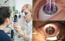 Операция на глаза: Преображение зрения и освобождение от очков!