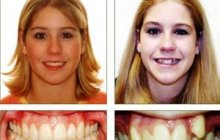 Выступающие зубы: коррекция