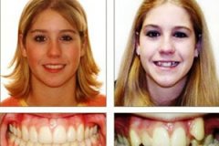 Выступающие зубы: коррекция